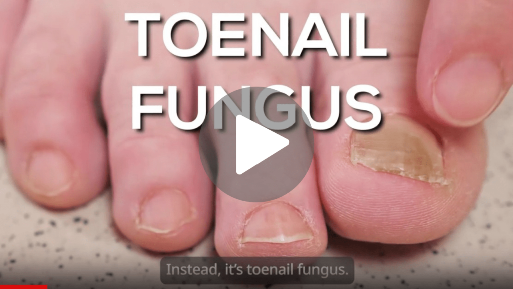 The Shocking Truth About Why Most Fungus Treatments Don’t Work- play-min